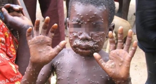 Afrika'da yeni salgın korkuya neden oldu